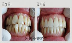 对于牙齿不齐应该怎么治疗