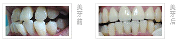 牙间隙过大困扰我好多年