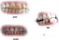 哪里治疗四环素牙较好