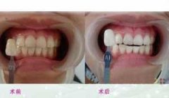 四环素牙和氟斑牙区别