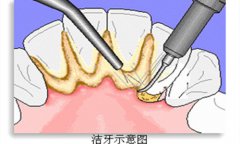进行超声波洗牙会感到痛吗