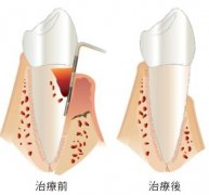 牙周病的病因盘点