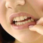 复发性口腔溃疡如何治疗