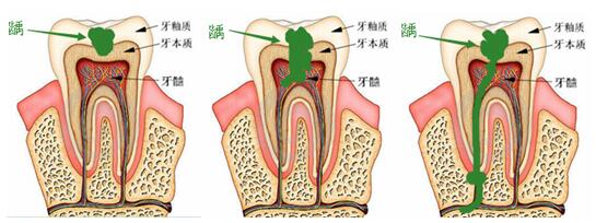 龋齿的病变引发牙髓炎