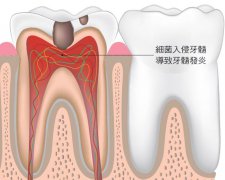 牙髓炎患者平时不宜吃哪些食物