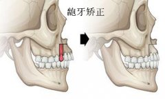 福州龅牙的矫正用什么方法好呢