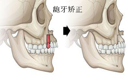 龅牙矫正