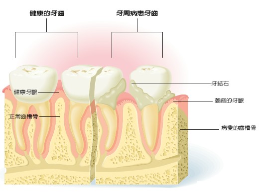 牙周炎会不会影响矫正牙齿