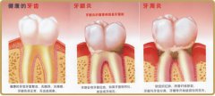 出现牙周炎后要怎么治疗呢