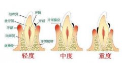 牙周炎都有哪些预防方法呢