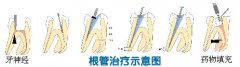根管治疗的操作步骤有哪些
