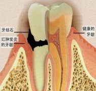 牙结石会引起口臭吗？