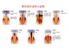 牙髓炎可以根管治疗么