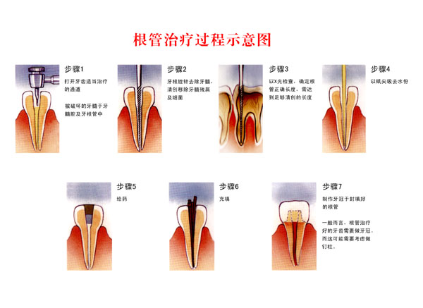 苏州牙髓炎可以根管治疗么