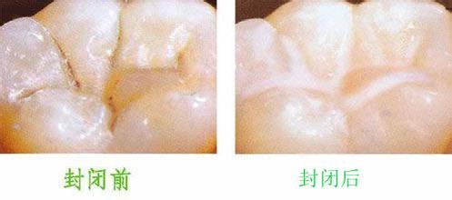 窝沟封闭
