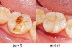 窝沟封闭的价格是多少