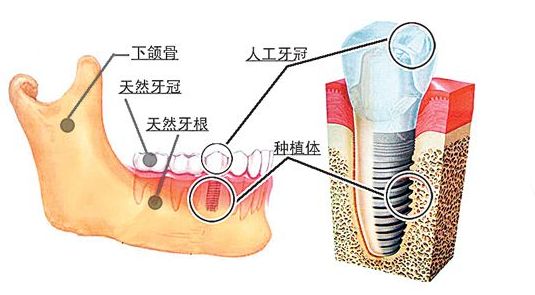 牙齿种植