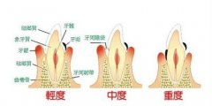 <b>福州患上牙周炎后会出现什么征兆</b>