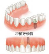 前牙选择种植牙修复可以使用多少年