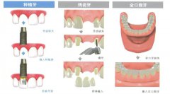 全口牙种植前做口腔检查的原因