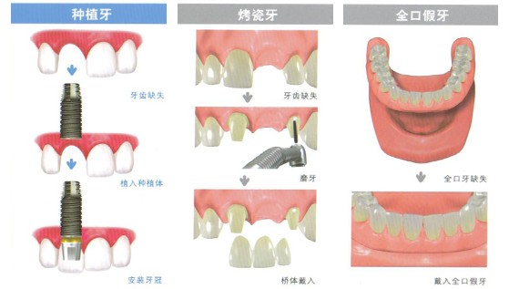 全口牙修复的几种方法比较