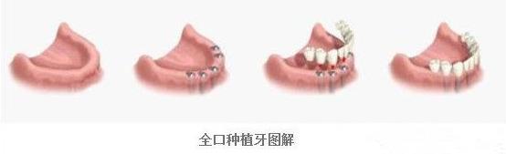 全口牙种植