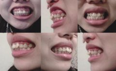 歪牙牙齿不齐矫正的牙齿是多少呢？