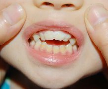 如果是孩子乳牙不整齐要矫正吗