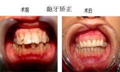 龅牙做矫正需要多长时间呢