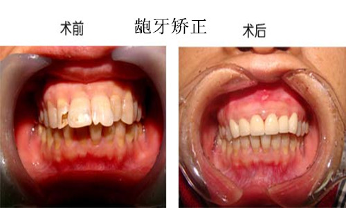 龅牙矫正