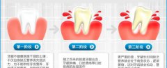 牙龈炎引起牙龈出血怎么办