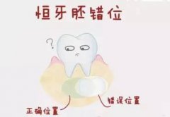 成人乳牙滞留怎么办