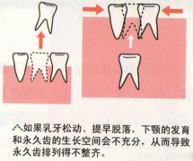 乳牙的蛀牙将影响永久齿的排列