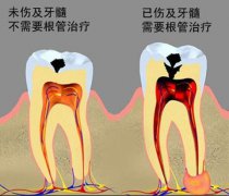 牙髓炎是怎么产生的呢