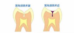 窝沟封闭成人可以做吗?