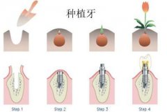 后牙种植后要注意什么