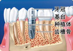 做半口牙种植适应症是什么