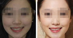龅牙还可以进行牙齿矫正吗