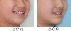 福州牙齿拥挤的三大危害