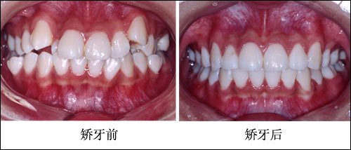 牙齿拥挤