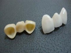 烤瓷牙或者美容冠有什么不同的地方呢