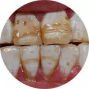 一般四环素牙的治疗费用是多少