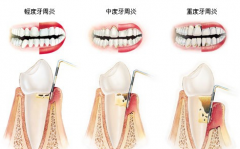 牙周炎治疗后怎么护理
