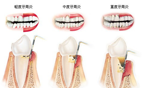 牙周炎