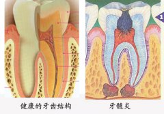 牙髓炎怎么治疗