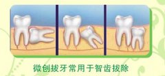 智齿什么时候要拔除
