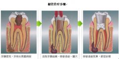 做根管治疗要注意什么