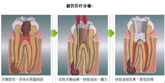 张家港做根管治疗要注意什么