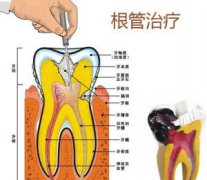 牙齿根管治疗需要多久