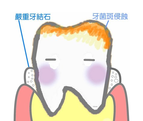 常熟清洁牙结石较好的方法是什么